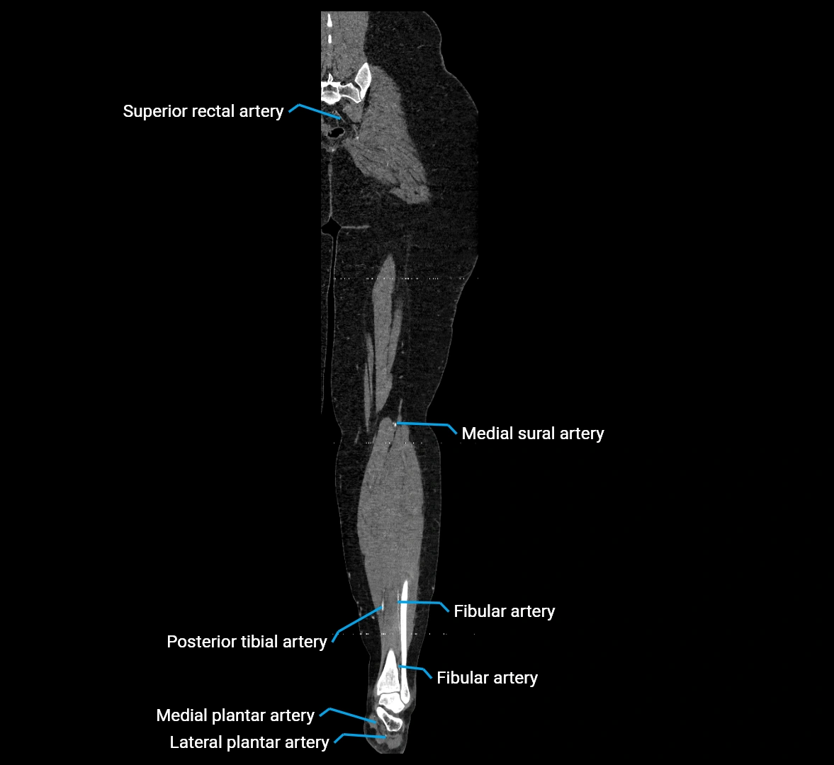 CTA lower limb coronal cross sectional anatomy labelled image _71 (2).webp